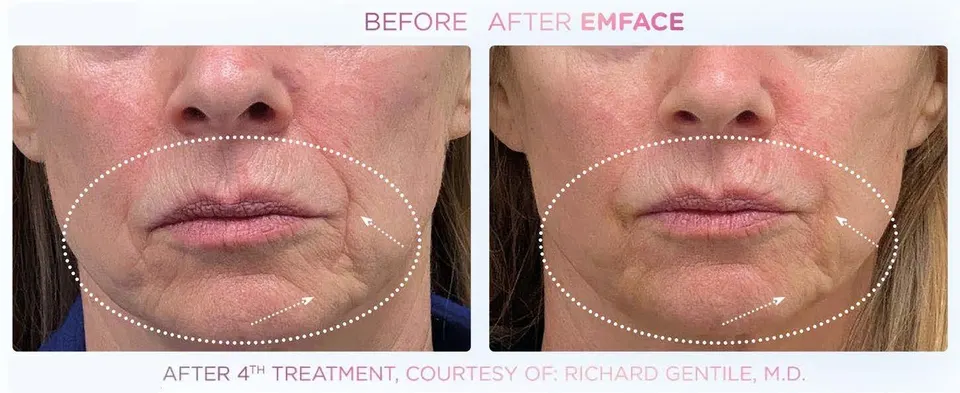 Emface effect on the mouth