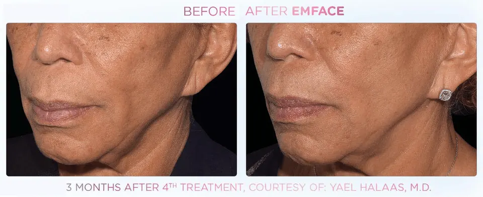 Emface effect on the cheeks