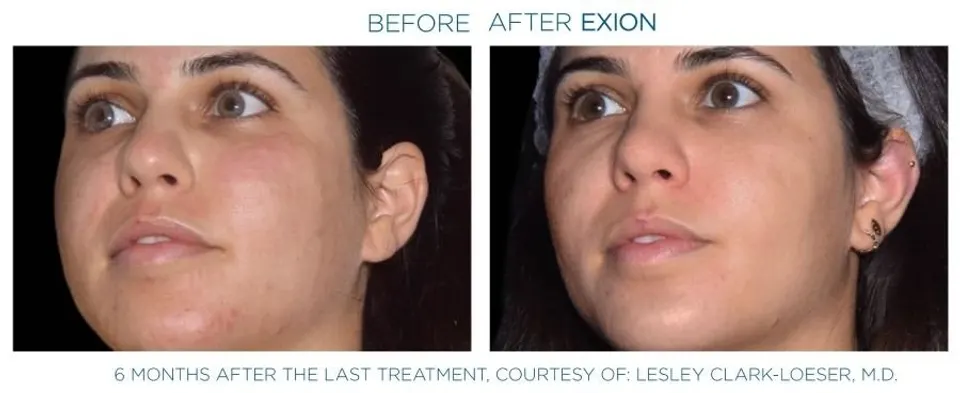 Exion effect on the face