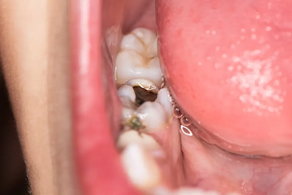 Dentist using digital X-ray to detect early cavity at Enclave Dental Lake Mary