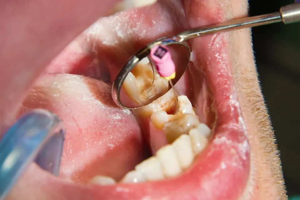 Illustration of bacteria causing acid demineralization on tooth enamel