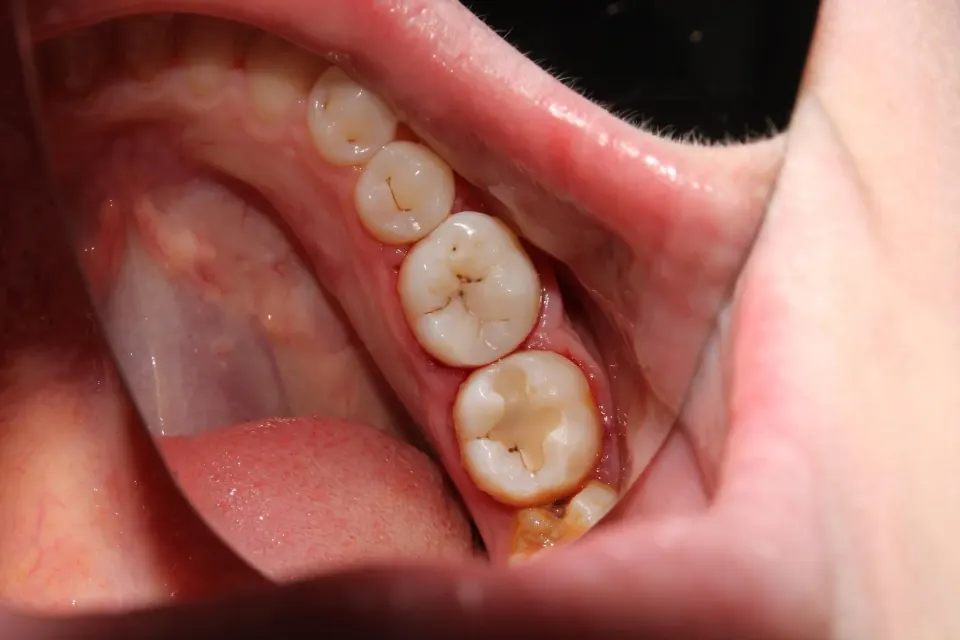 Diagram showing five stages of tooth decay progression from enamel to abscess