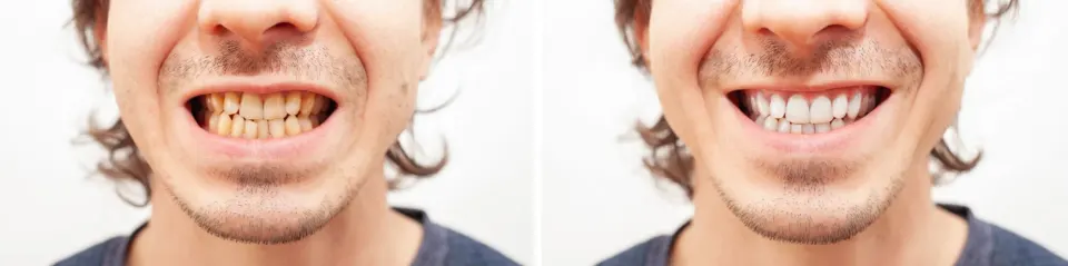 Clear Aligners in Lake Mary - Before and After
