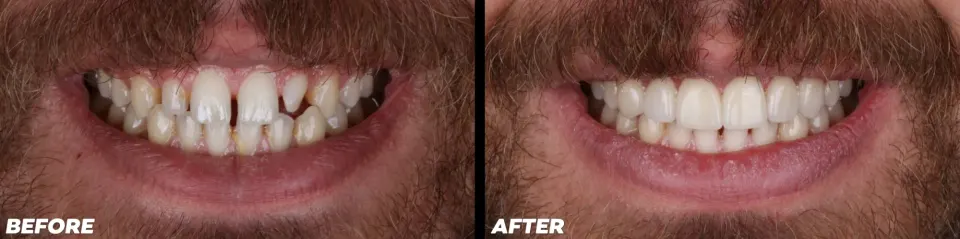 Clear Aligners in Lake Mary - Before and After