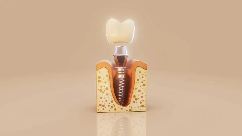 Emergency Dental Care for Broken or Chipped Teeth