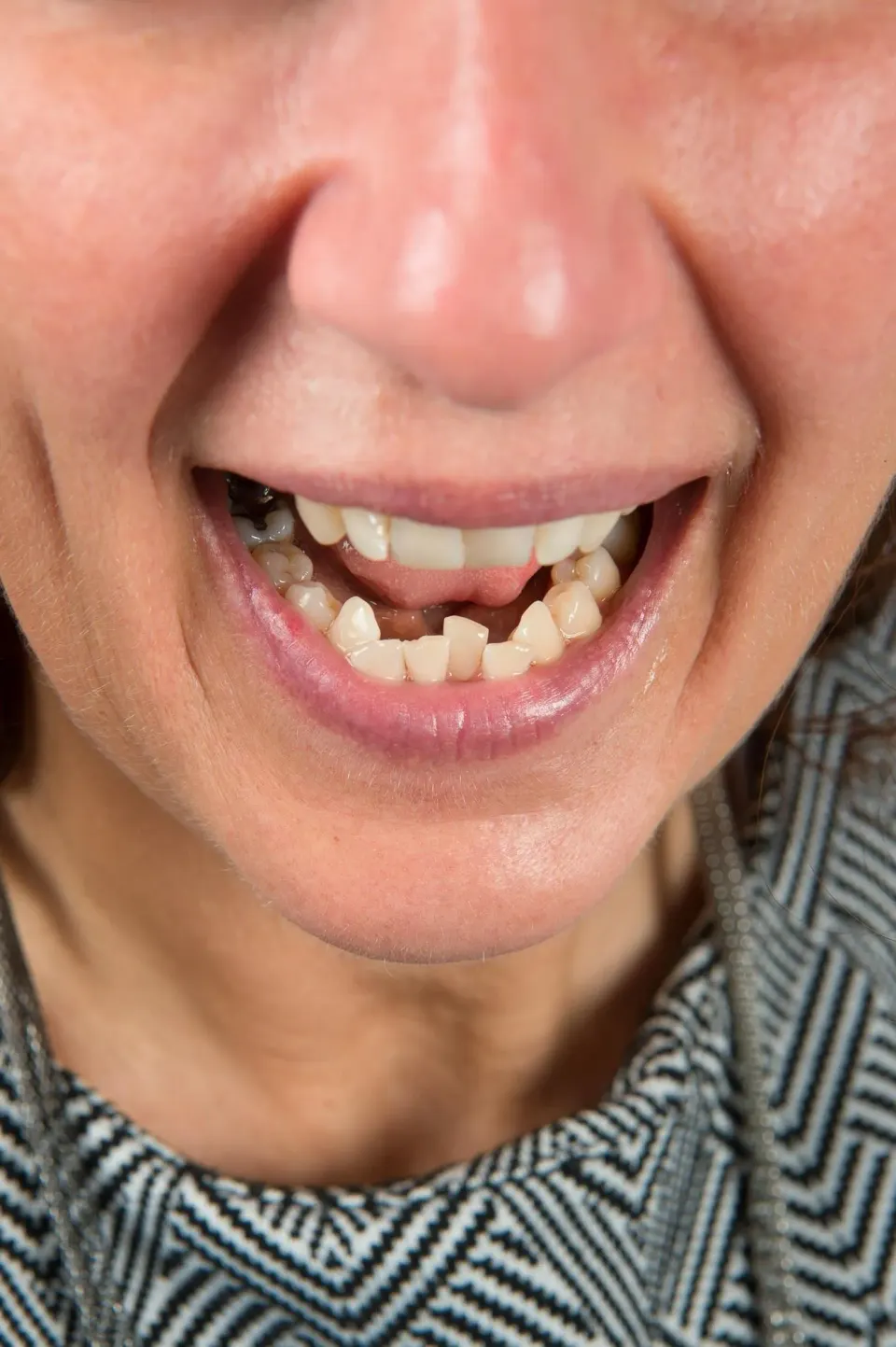 Close-up of crowded and crooked teeth before orthodontic treatment