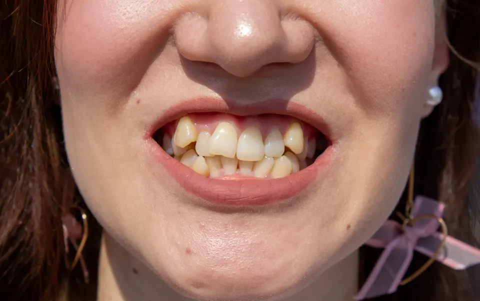 Diagram showing causes of crooked teeth including genetics and jaw development
