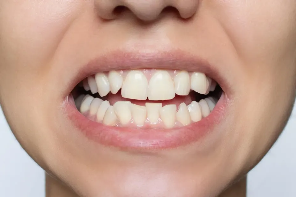 Dental professional explaining crooked teeth and oral health impacts to a patient