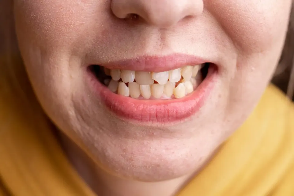 Illustration of various factors contributing to crooked teeth misalignment