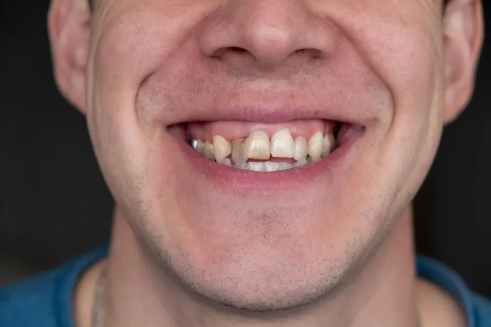 Patient looking in mirror noticing crooked or misaligned teeth