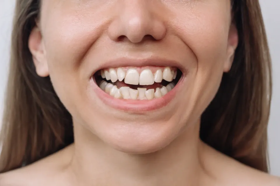 Patient smiling after crooked teeth treatment at Enclave Dental in Lake Mary FL