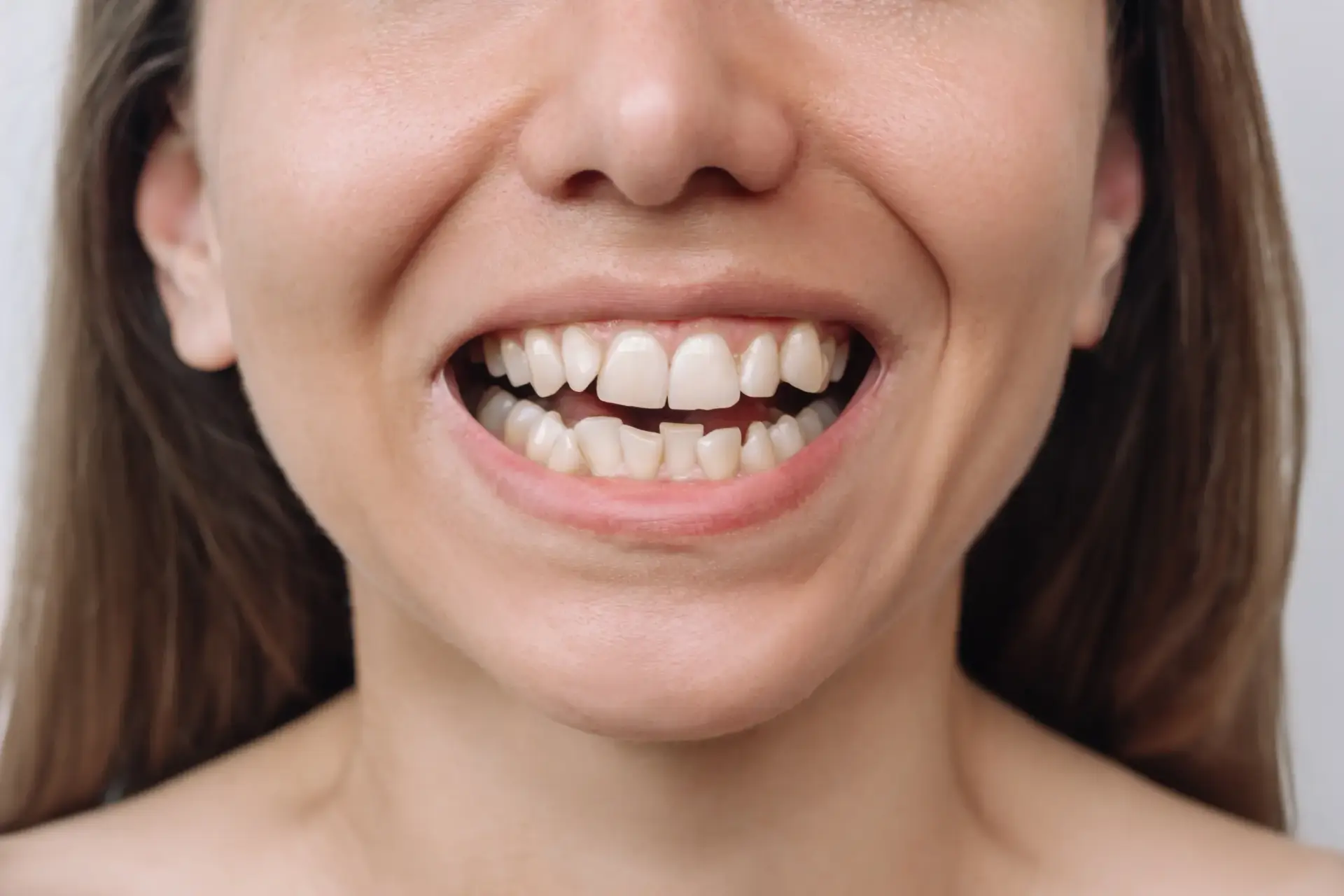 Patient smiling after crooked teeth treatment at Enclave Dental in Lake Mary FL