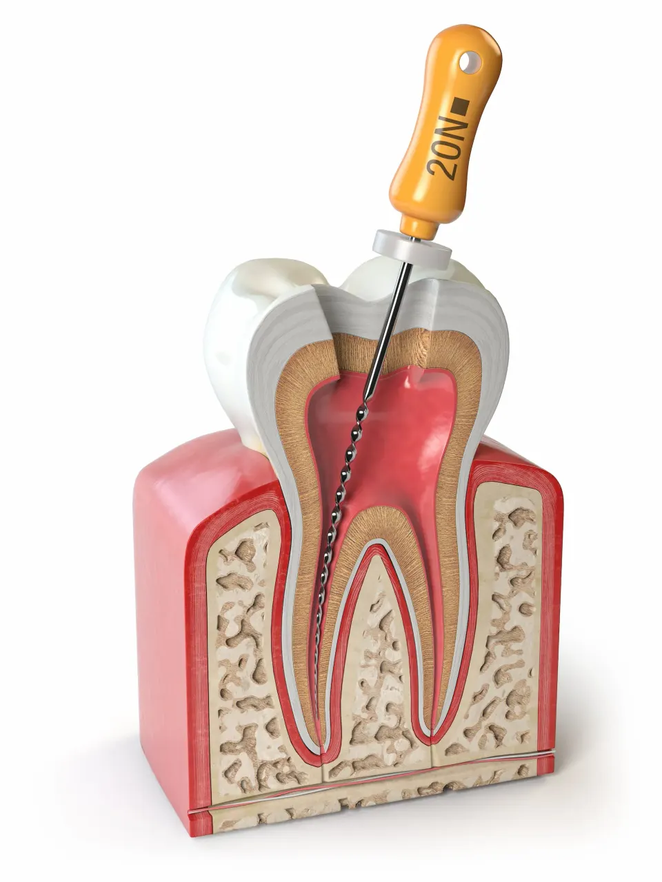 Close-up of dental rotary instruments used for root canal at Enclave Dental Lake Mary