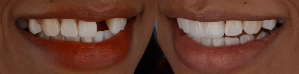 Dental Bridges in Lake Mary - Before and After