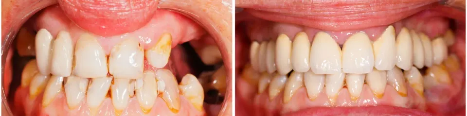 Dental Bridges in Lake Mary - Before and After