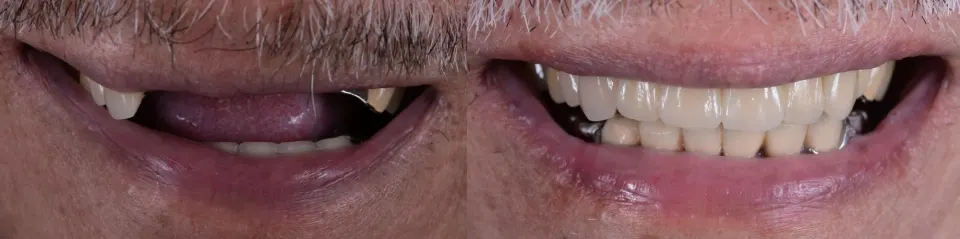 Dental Bridges in Lake Mary - Before and After