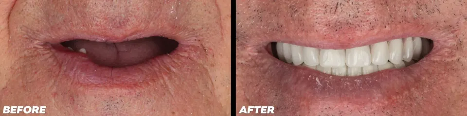 Dental Implants in Lake Mary - Before and After