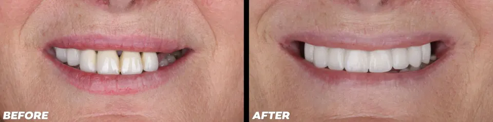 Dental Implants in Lake Mary - Before and After