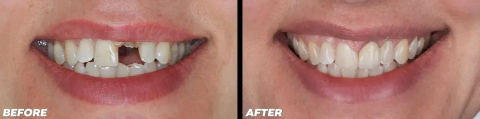 Dental Implants in Lake Mary - Before and After