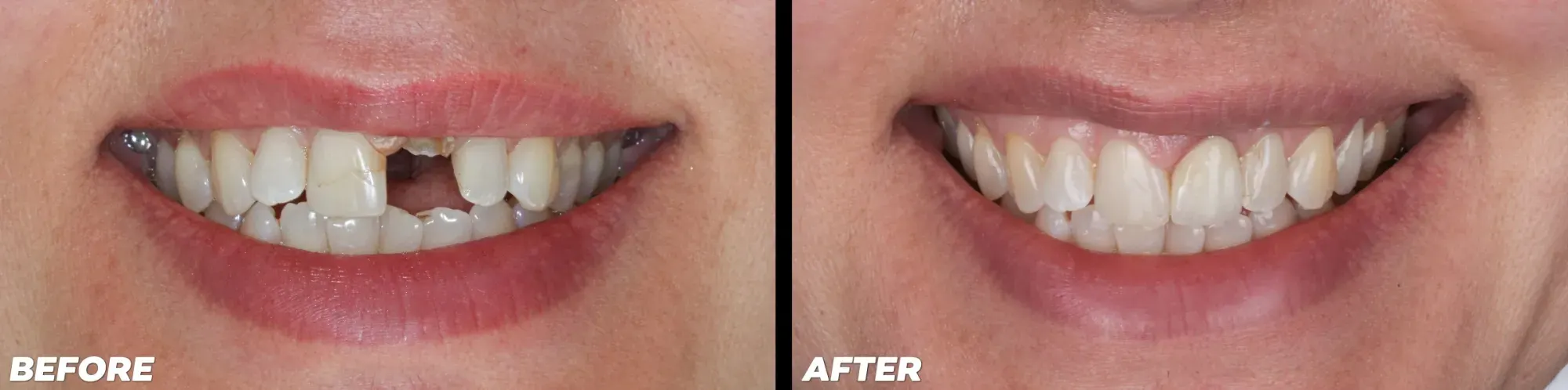 Dental Implants in Lake Mary - Before and After