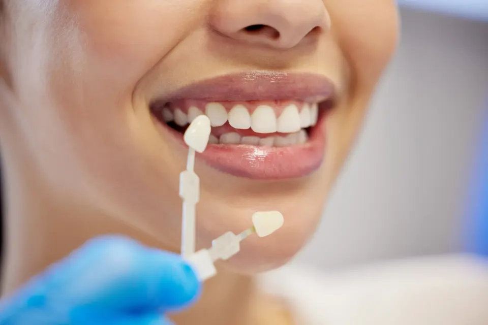 Close-up of a patient's beautiful smile showing porcelain dental veneers during a cosmetic dentistry consultation