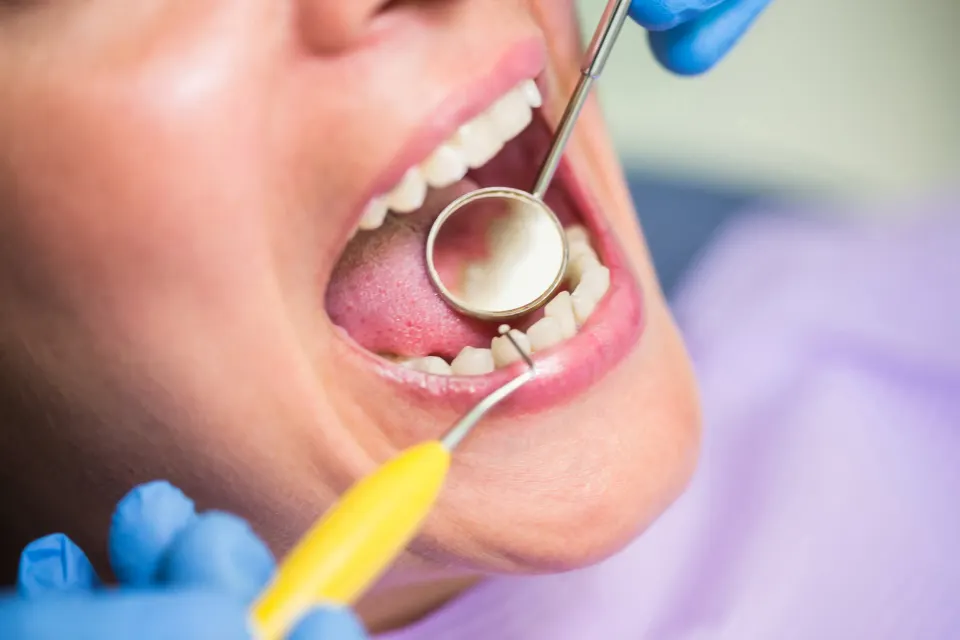 How to Prepare for a Root Canal