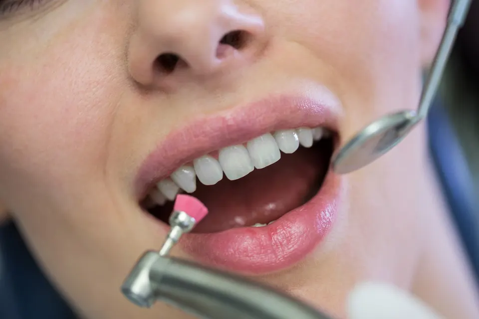 Enameloplasty tooth reshaping treatment at Enclave Dental in Lake Mary, FL