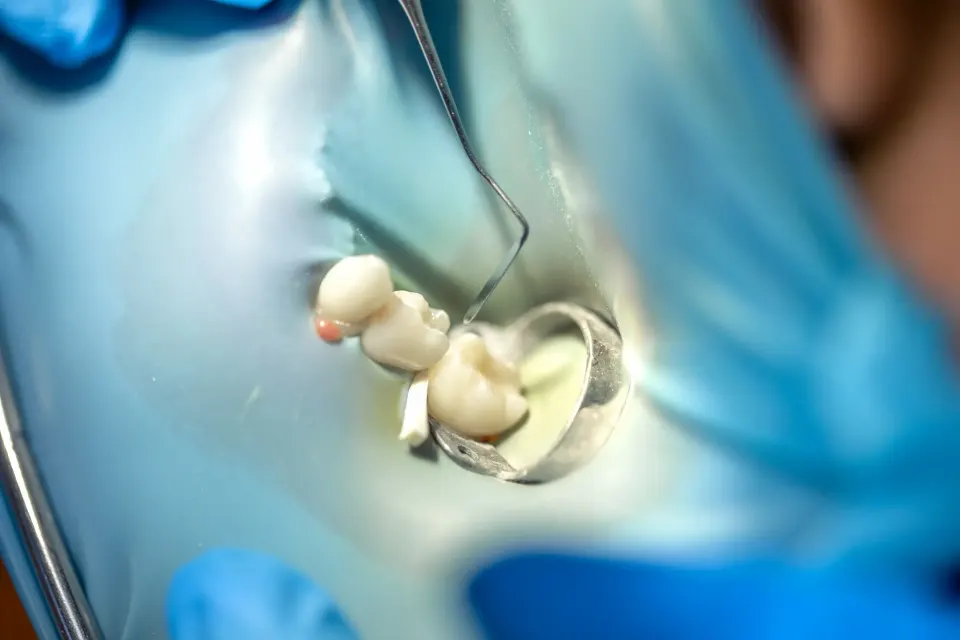 What to Do If a Dental Crown or Filling Falls Out