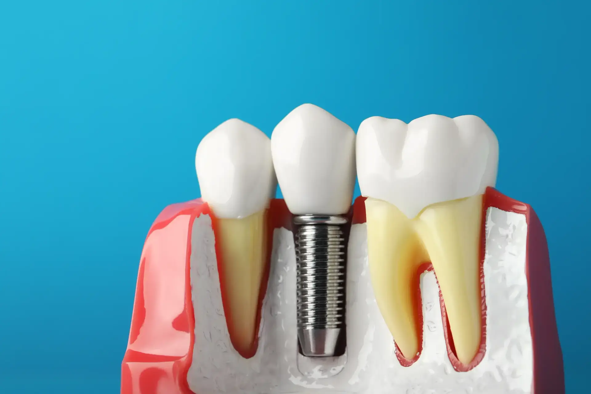 Enhancing Your Smile: How Dental Implants Improve Aesthetics