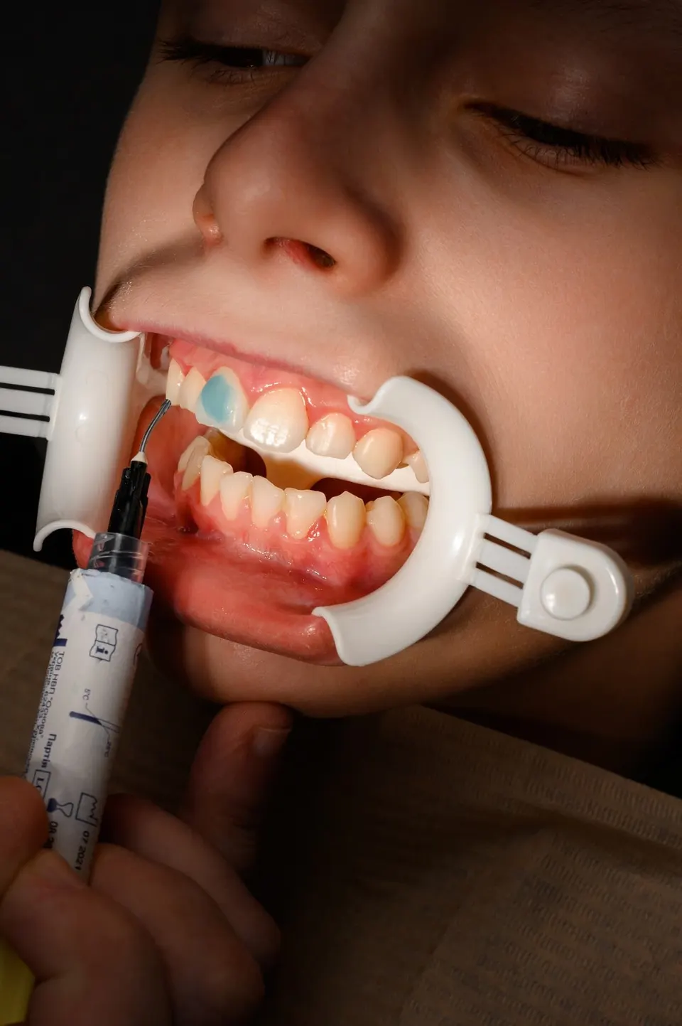 Composite resin dental bonding materials and tools at Enclave Dental