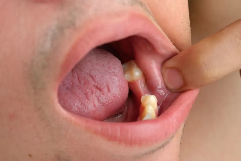 Illustration of common causes of tooth loss including decay and gum disease