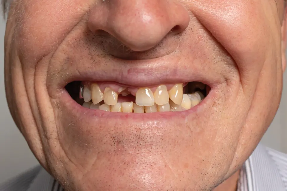 Diagram showing bone loss progression after tooth extraction