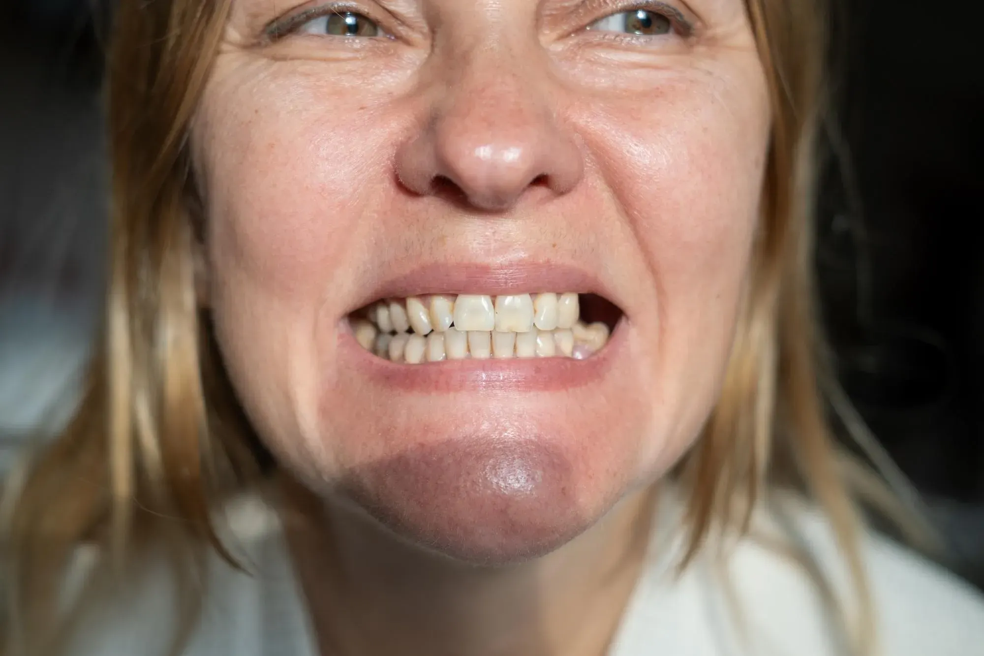 Visual showing different causes of tooth loss in adults