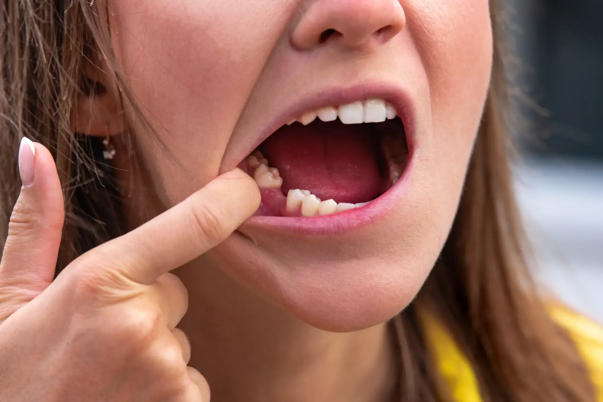 Patient smiling after missing teeth replacement at Enclave Dental in Lake Mary, FL