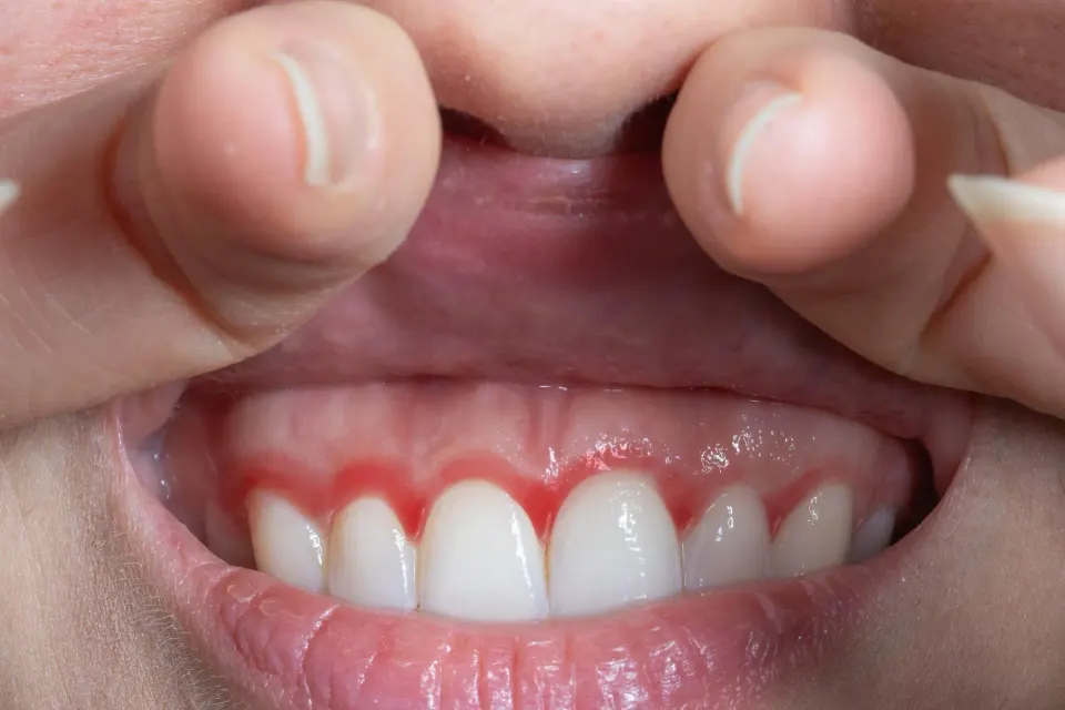 Infographic showing the six most common causes of tooth sensitivity including enamel erosion and gum recession