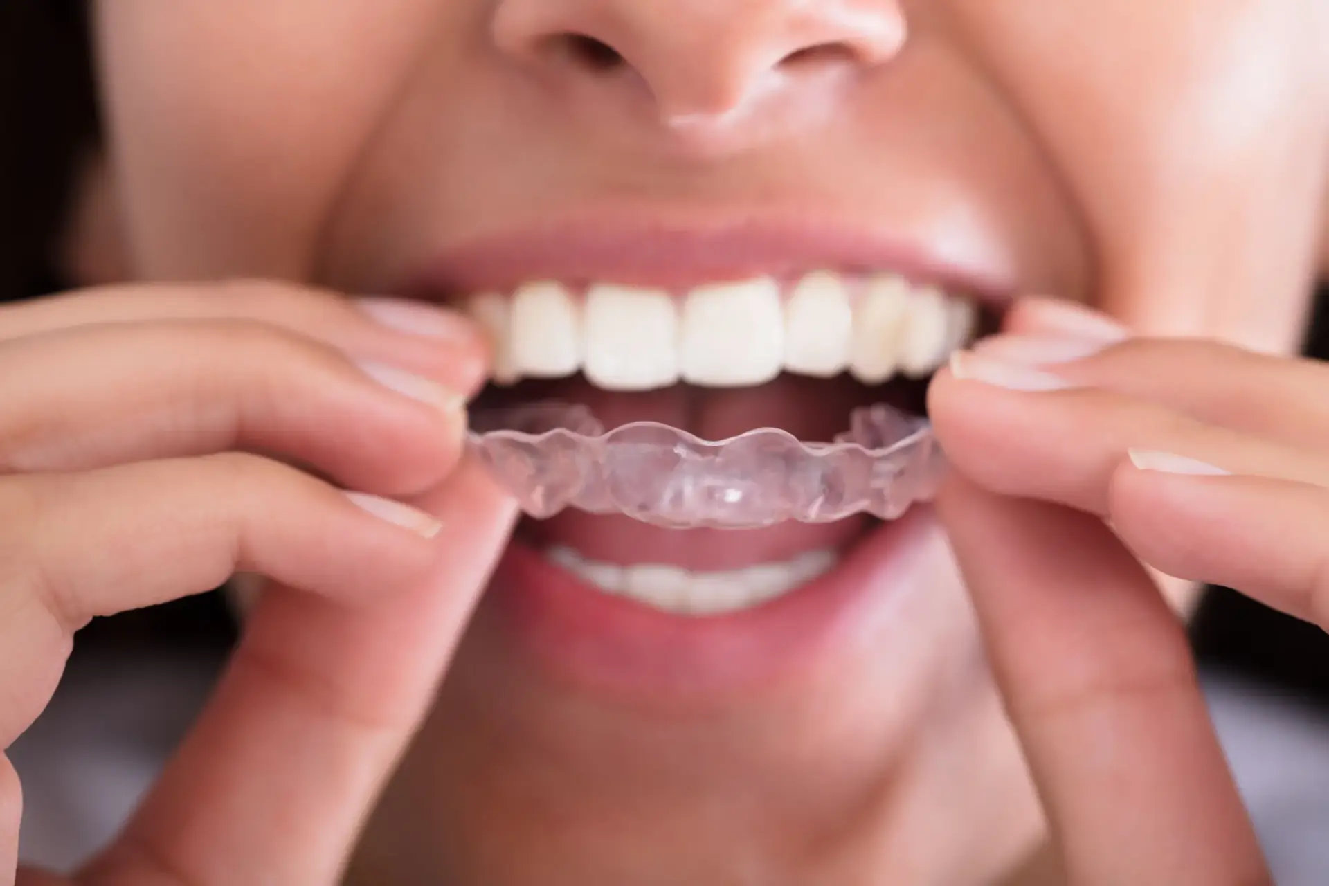 Patient consulting with dentist about teeth grinding treatment at Enclave Dental in Lake Mary FL