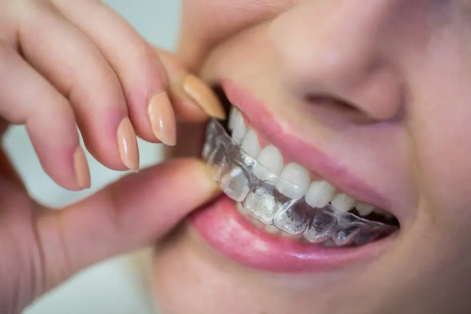 Invisalign Treatment Step-by-Step: What to Expect