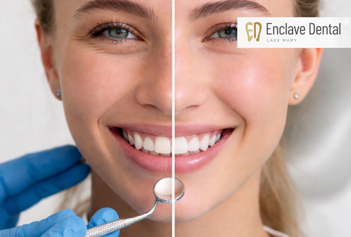 before and after veneers